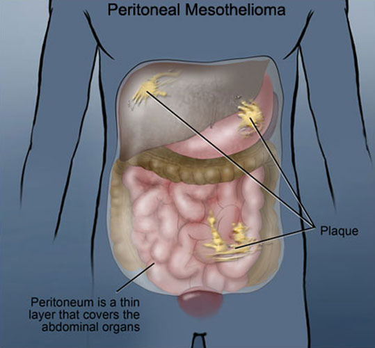 treatment-of-peritoneal-mesothelioma-and-its-causes-mesothelioma