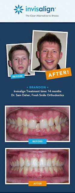 Invisalign Before and After Boy #ad #INVStraightTalk