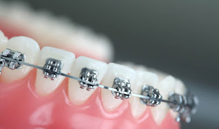 عروض تقويم الاسنان في جدة