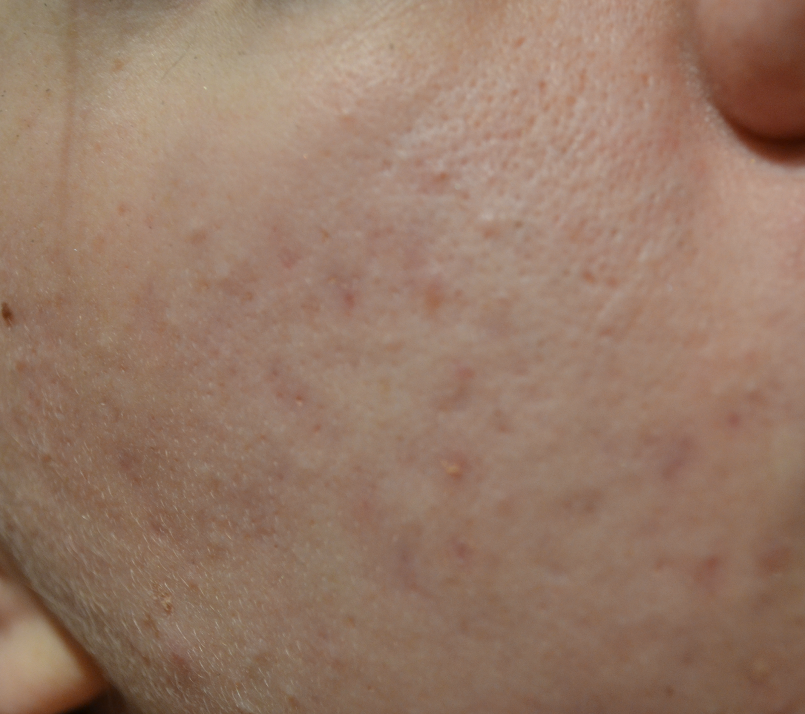 mild-acne