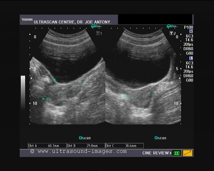 Ultrasound and Color Doppler videos October 2011