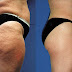Causes of cellulite, anti cellulite treatments and solutions