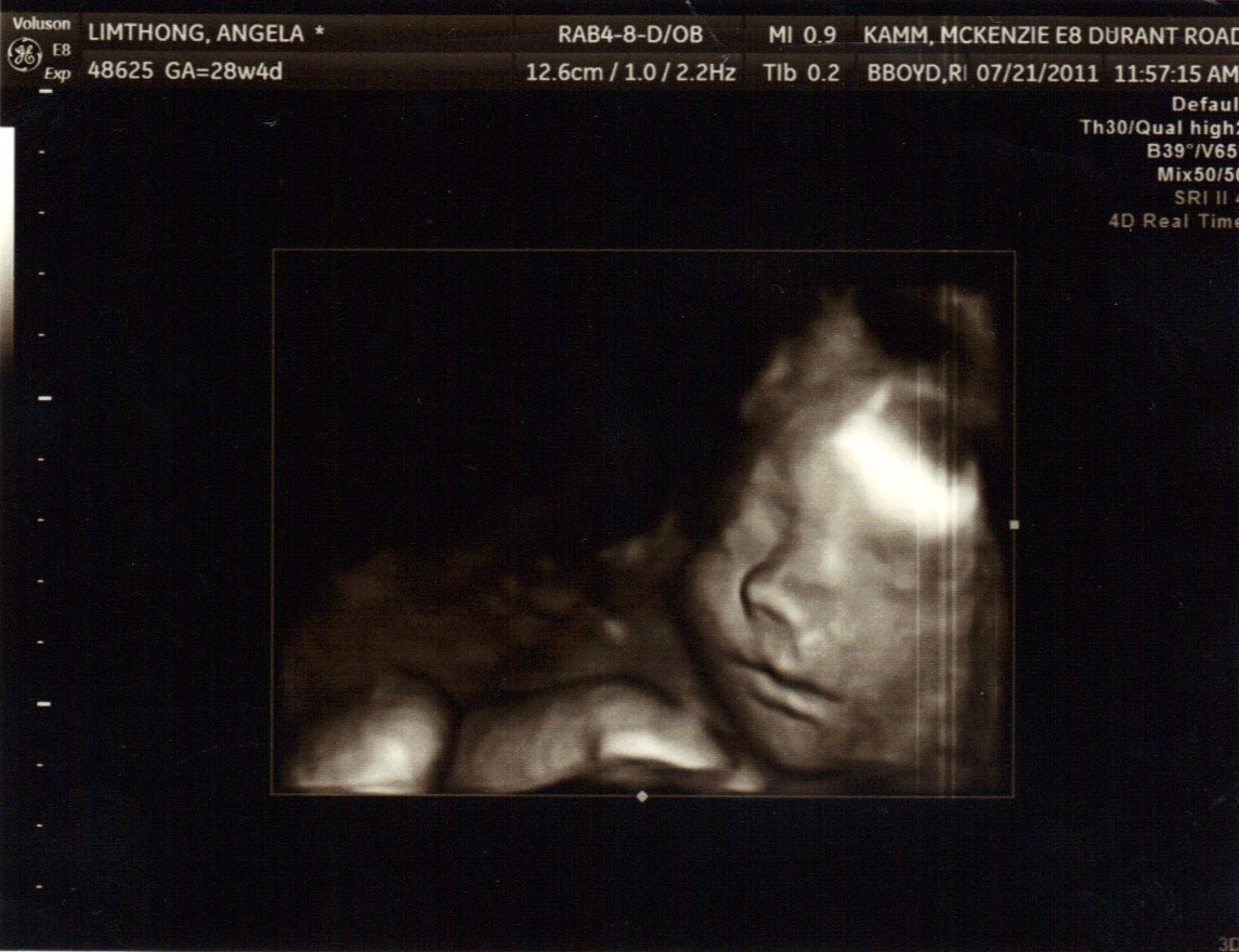 3d sonogram pictures 3d sonogram pictures