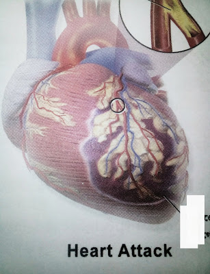 Symptoms of heart attack in man or women 