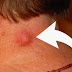 YOU DO NOT HAVE TO GO TO SURGERY: HERE’S HOW YOU CAN REMOVE ALMOST ALL TYPES OF CYSTS AT HOME
