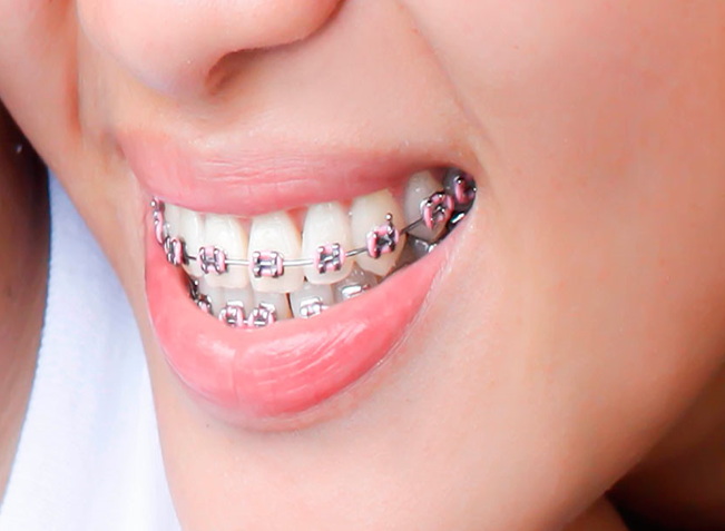 Brackets