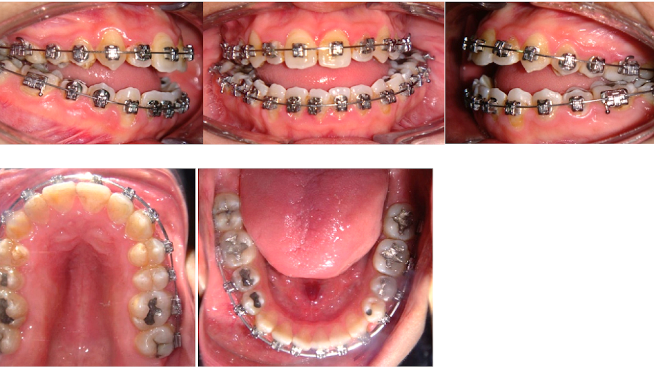 Which Teeth Are Frequently Extracted For Orthodontic Treatment
