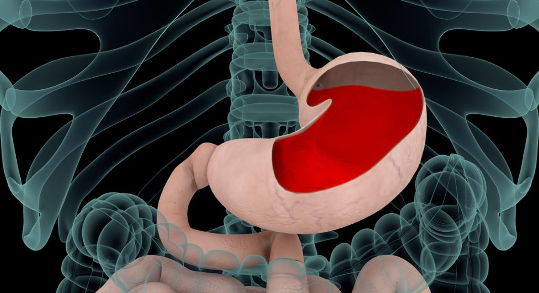 Do Not Eat These 5 Foods If You Have Heartburn or Acid Do Not Eat These 5 Foods If You Have Heartburn or Acid
