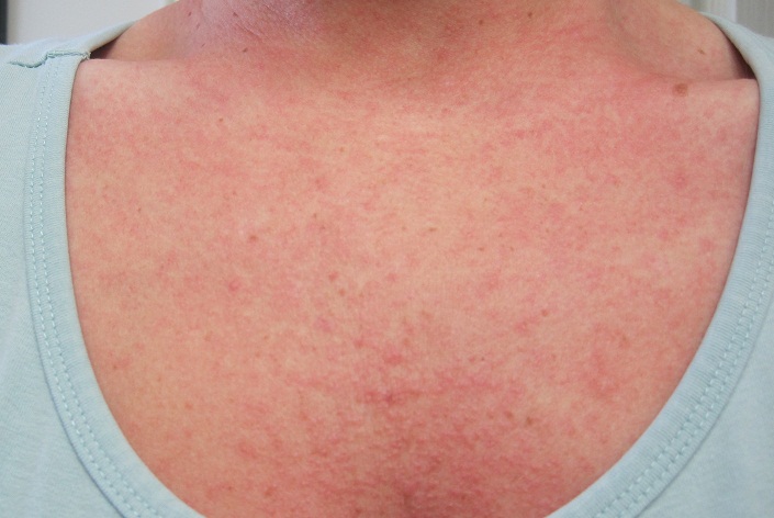 sjogren's skin rash pictures | Lifescript.com