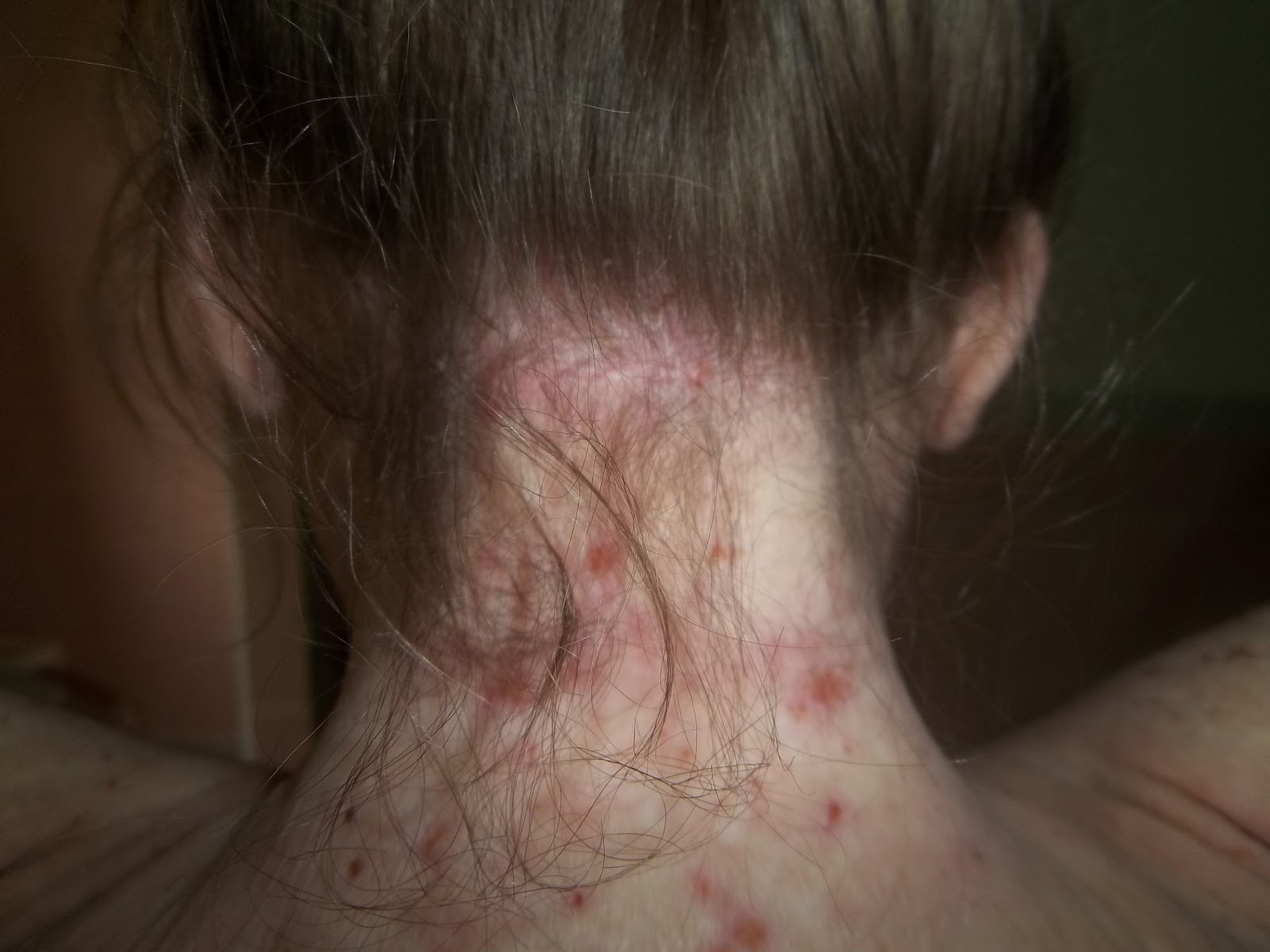 Doctor insights on: Rash On Back Of Neck Near Hairline