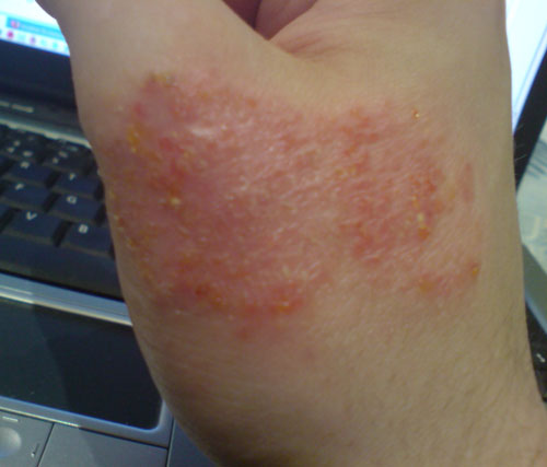 Atopic Dermatitis — NEJM