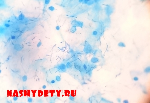 Corynebacterium pseudodiphtheriticum норма. Коринебактерии дифтерии мазок. Коринебактерии дифтероиды. Дифтероиды в мазке на флору. Corynebacterium diphtheriae микроскоп.