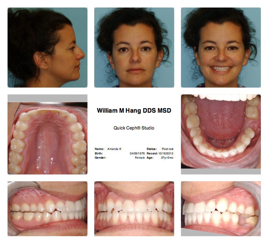 Braceface The Sequel (a jaw surgery and braces blog) Braceface One