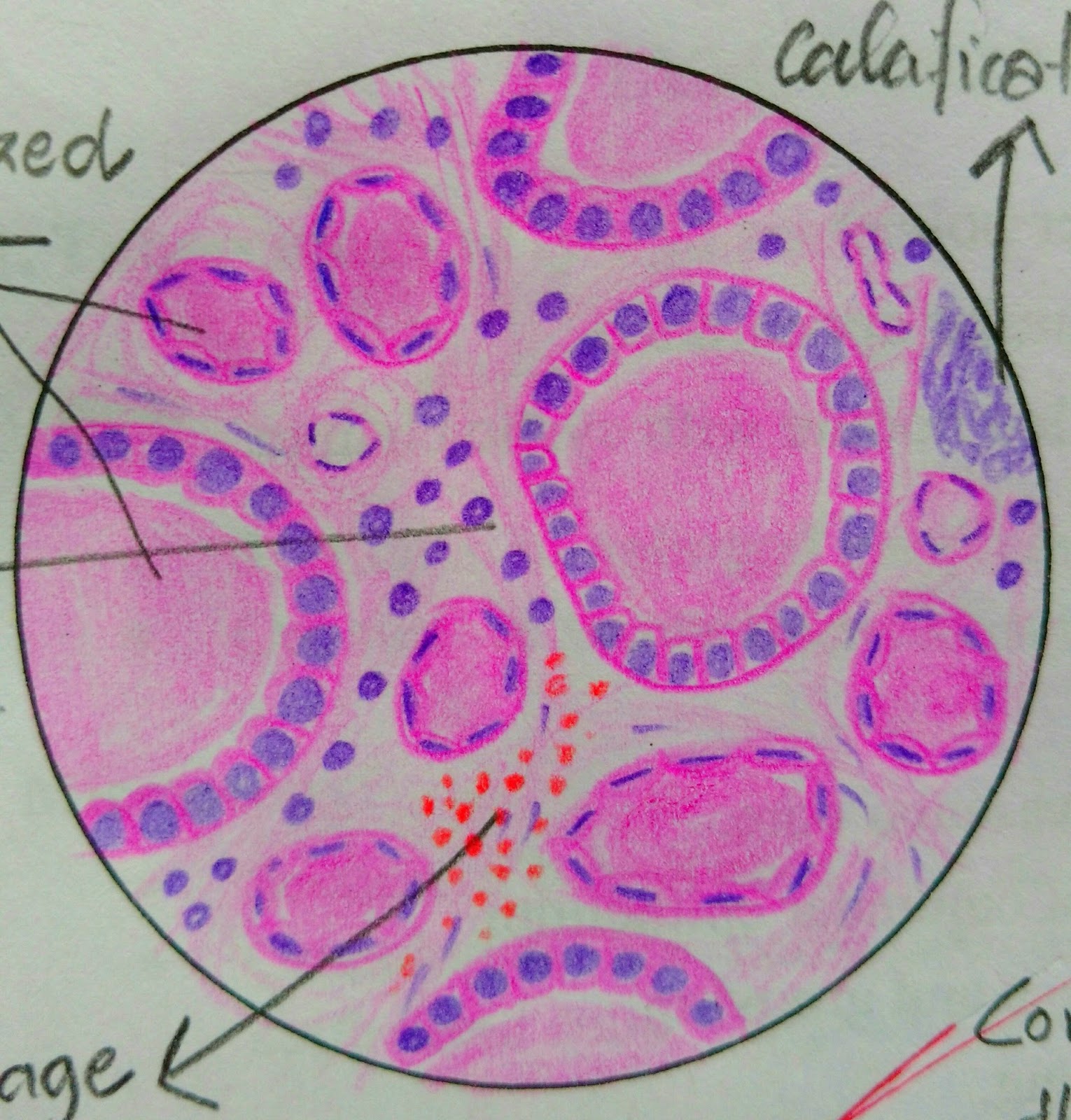 Histopathology Drawings Nodular colloid goitre