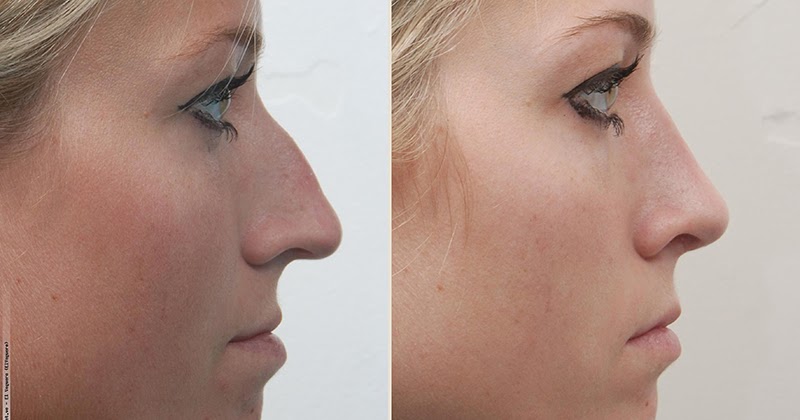 Precisa malhar quem tem prótese no bumbum?