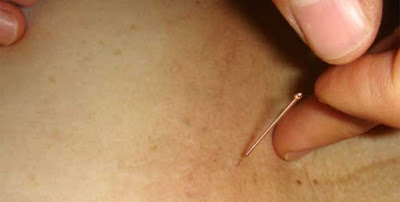 acupuntura para tratar latigazo cervical
