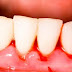 Răng chảy máu do thiếu vitamin gì?