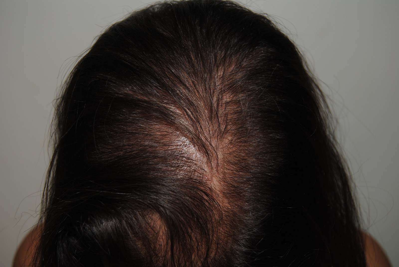Babosa de mar impulso Saturar Dermatologo-Valencia: Se me cae el pelo, tratamientos para la caída de  cabello...¿por qué me cae el pelo? Algunas preguntas con respuesta en la  caída del cabello
