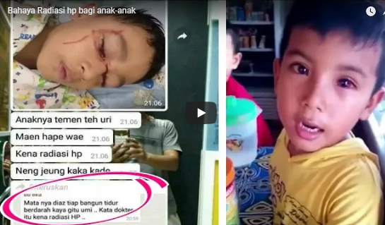 Berdarah-Darah, Matanya Bocah Karawang Diduga Akibat Kelamaan Main Hp! Ini Kata Dokter