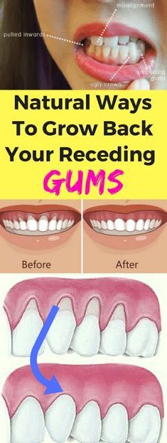 Here Are 3 Natural Ways To Grow Back Your Receding Gums!!!