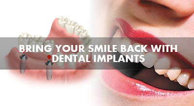  Save Your Smile with Dental Implants 