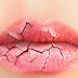 Awas Jangan Dikelupas loh! Ini 7 Penyebab Utama Mulut dan Bibir Kering.