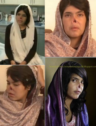 Wajah Terbaru Bibi Aisha: Perempuan Afganistan Yang Di 