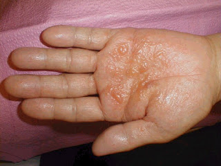 Ahlinya Obat Gatal Ahlinya Obat Gatal