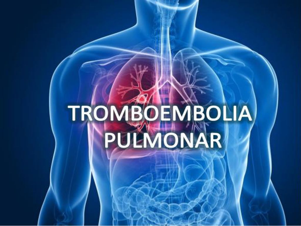 Mi TEP TromboEmbolismo Pulmonar por TP Tendinitis Poplítea y mi SPT Síndrome PosTrombótico