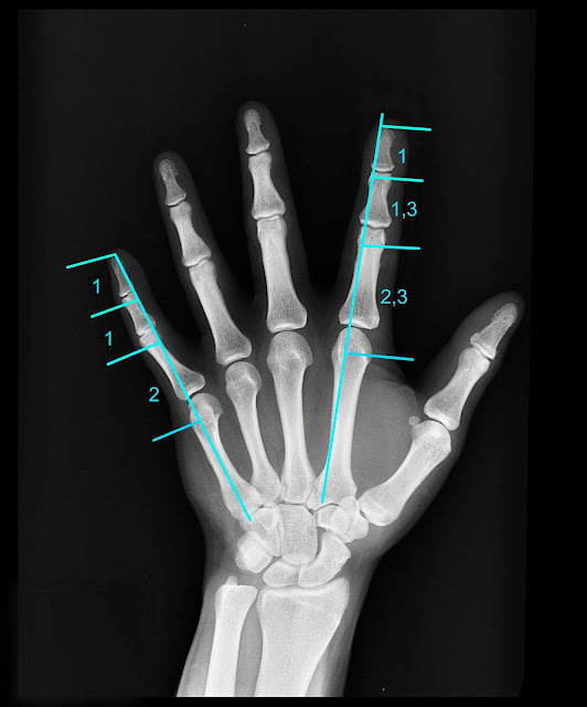 Proporción correcta de las falanges y metafalanges del segundo al quinto dedo.