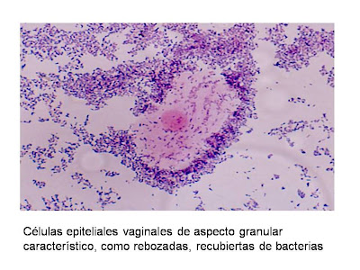 Vaginosis bacteriana