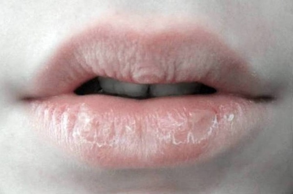 12 Natural Home Remedies to Cure Dry, Chapped and Cracked