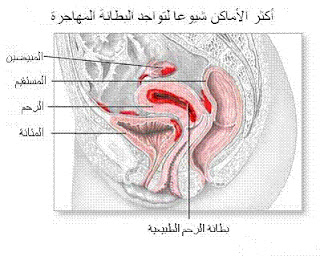 Endometriosis, البطانة الهاجرة,بطانة الرحم الهاجرة