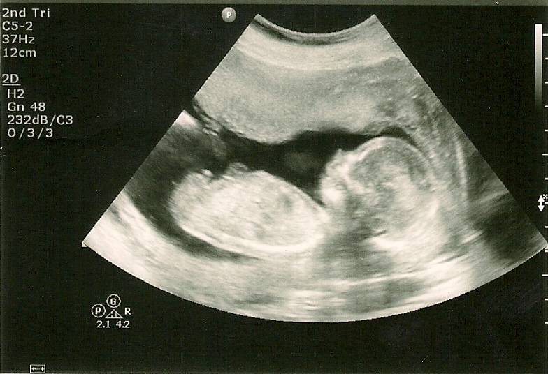 Малыш на 23 неделе. УЗИ на 6 месяце беременности. 23 Недели беременности фото плода на УЗИ. УЗИ ребенка на 23 неделе беременности. Снимок УЗИ на 23 неделе беременности.