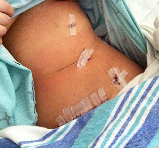 kidney donor organ donation surgery recovery scar