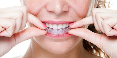 Các phương pháp chỉnh nha niềng răng móm