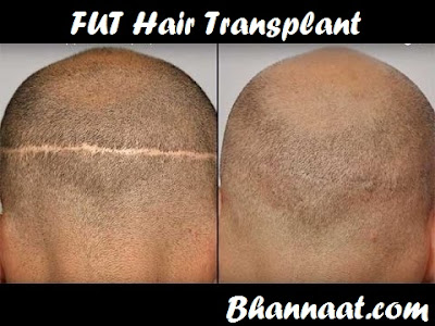 What is Hair Transplant