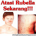 Obat Rubella Ampuh Untuk Anak