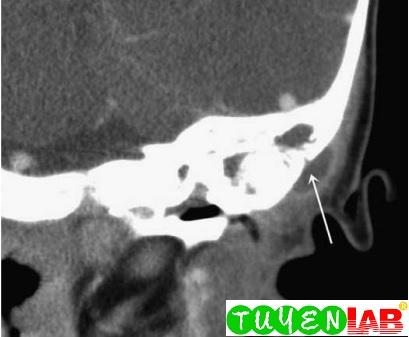 [Pediatric] Atlas of Mastoiditis | Free Medical Atlas