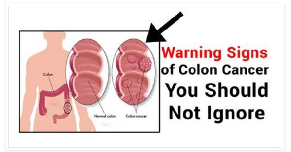 early signs of colon cancer symptoms