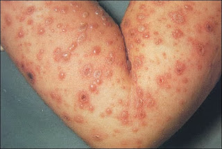 Obat Herpes pada Tangan yang Mujarab