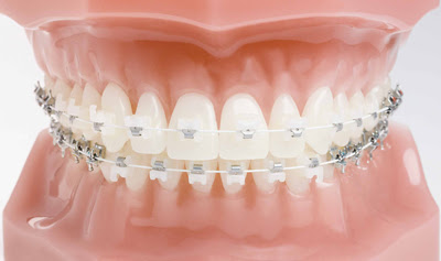 Ortodontia.com.Borel: Aparelho Estético ou Metálico? (Tipos de Aparelhos)
