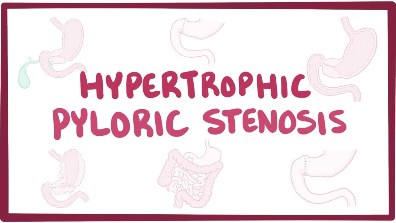 Pyloric stenosis