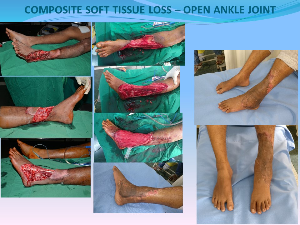 CRUSH INJURY FOOT, LOWER LIMB INJURIES AND LIMB SALVAGE: CRUSH INJURY LEFT  LEG AND ANKLE - NEGATIVE PRESSURE WOUND THERAPY - LATISSIMUS DORSI FREE  FLAP COVERAGE - OUTCOME