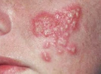 Pengobatan herpes Pengobatan herpes