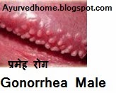 Gonorrhea Disease Treatment, Suzak Rog,  प्रमेह रोग का उपचार