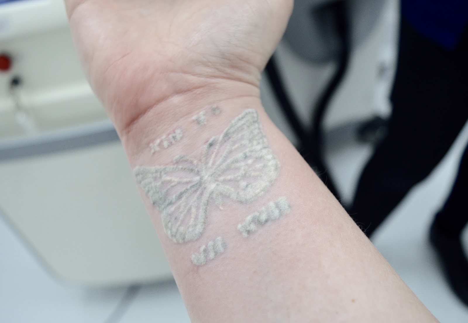 Lifestyle Review My Laser Tattoo Removal Journey POPCORN AND GLITTER