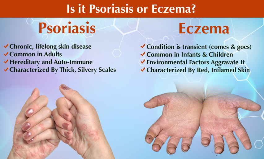 Mengenal Psoriasis Penyebab dan Pengobatannya Nona Melinda