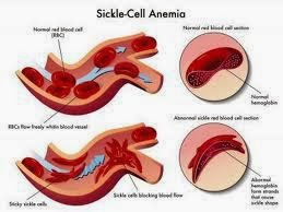 Cara Menyembuhkan Penyakit Anemia