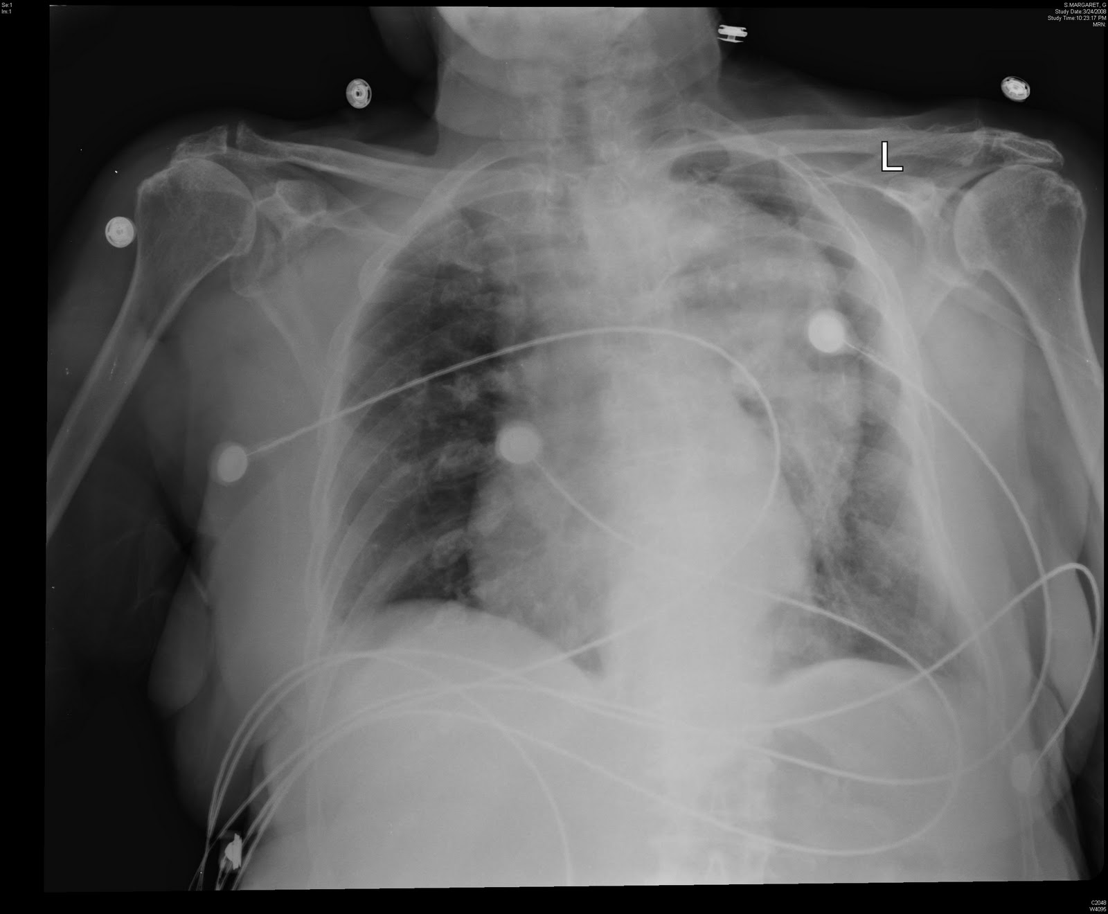 HEALTH FROM TRUSTED SOURCES Aortic Dissection HEALTH FROM TRUSTED SOURCES Aortic Dissection